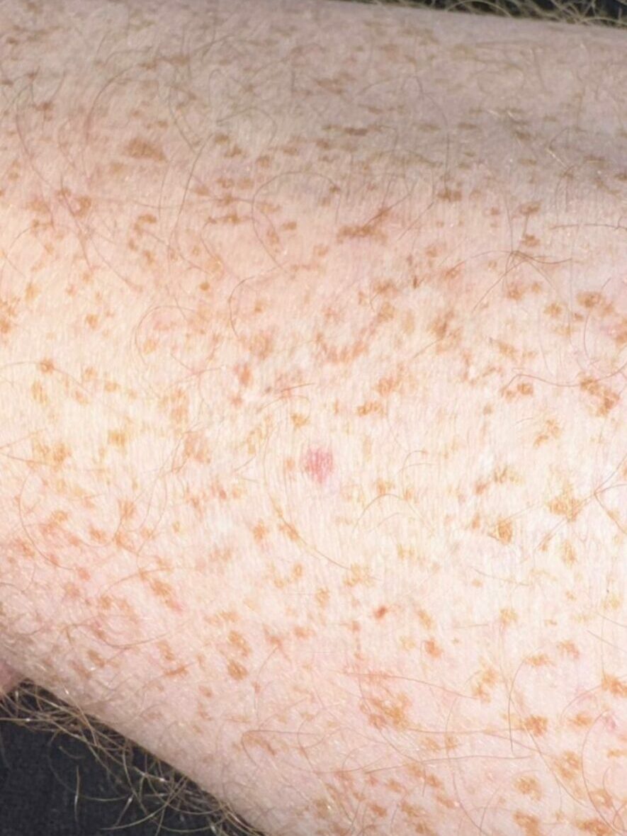 Luke Hamnett's mole