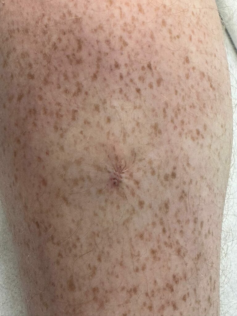Luke Hamnett's mole after removal