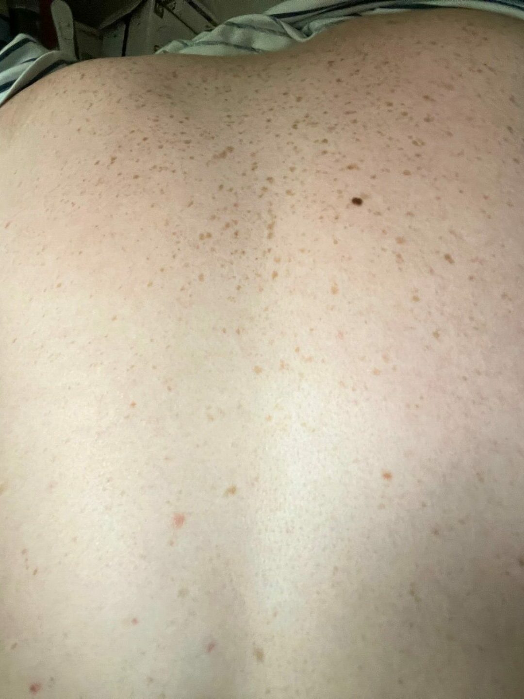 Luke Hamnett's mole
