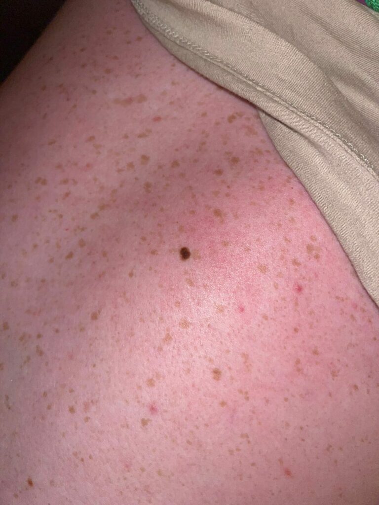 Luke Hamnett's mole