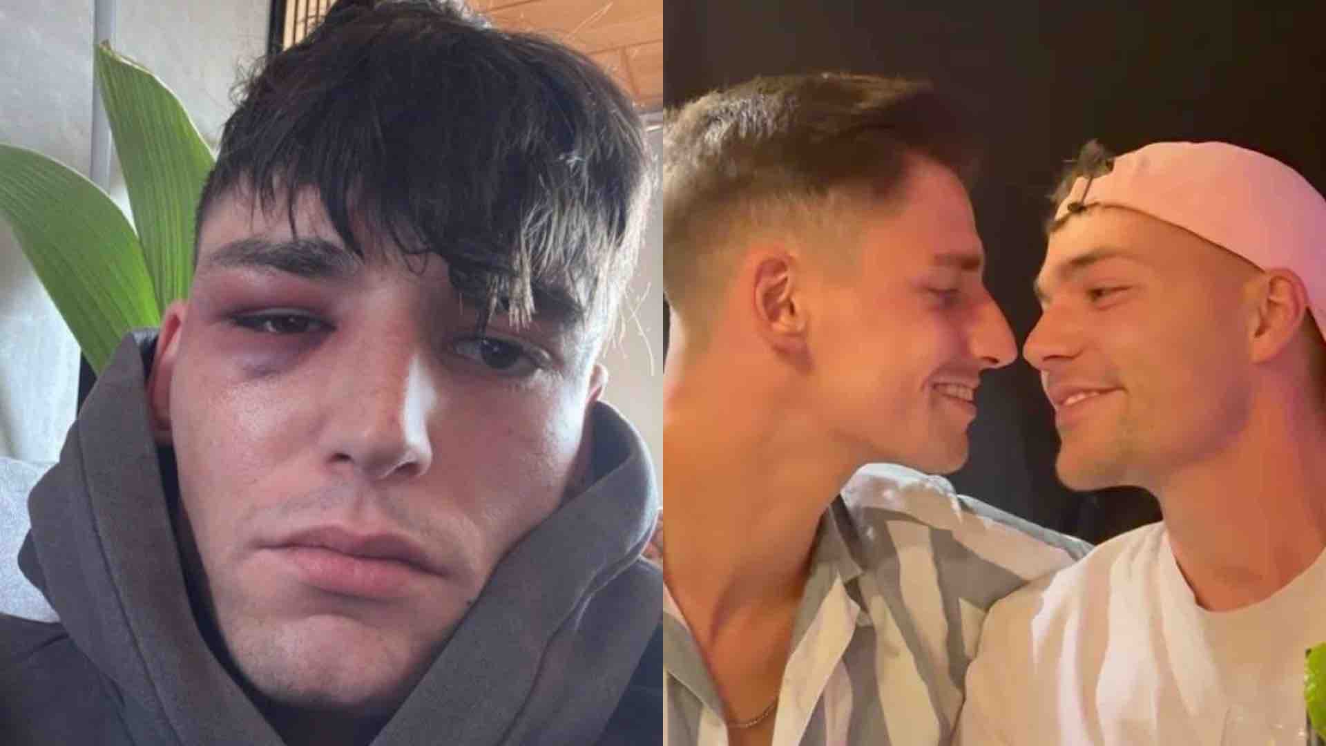 Pascal Kaiser injuries to his right eye on the left and Kaiser with his boyfriend Moritz smiling closely into each other's eyes on the right